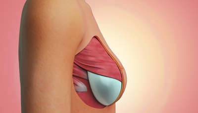 BREAST RECONSTRUCTION SURGERY