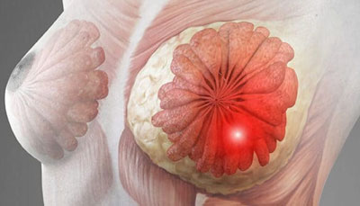 NIPPLE SPARING MASTECTOMY VS. TRADITIONAL MASTECTOMY